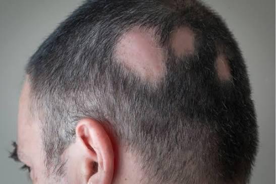 Alopecia Areata: