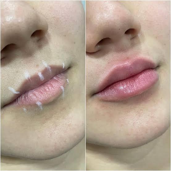 PREENCHIMENTO LABIAL