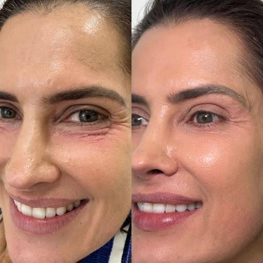 PEELING DE ATA NA ESTÉTICA