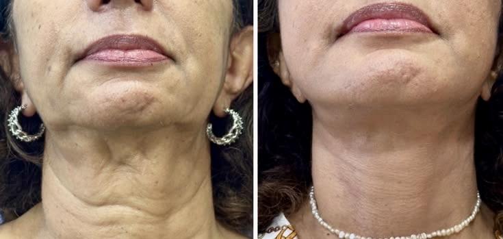Cirurgião plástico baiano explica tudo sobre o lifting de pescoço Deep Neck