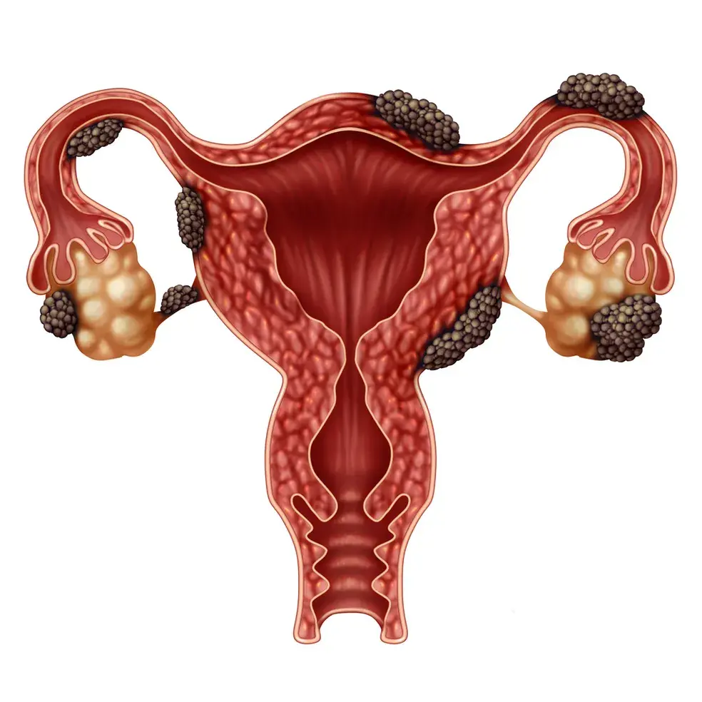 Endometriose: doença pode comprometer a qualidade de vida e ainda levar anos para ser diagnosticada