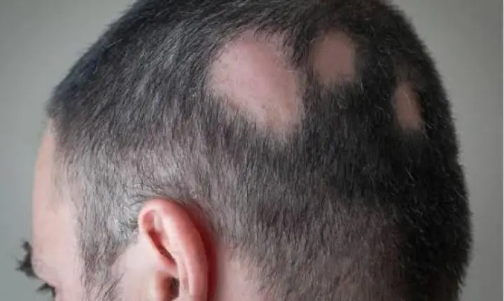 Alopecia Areata: