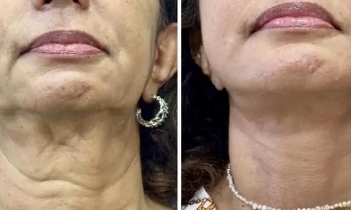 Cirurgião plástico baiano explica tudo sobre o lifting de pescoço Deep Neck