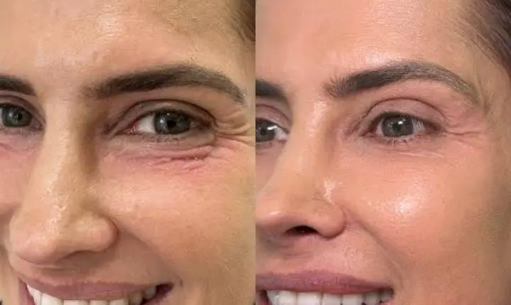 PEELING DE ATA NA ESTÉTICA