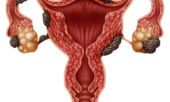 Endometriose: doença pode comprometer a qualidade de vida e ainda levar anos para ser diagnosticada